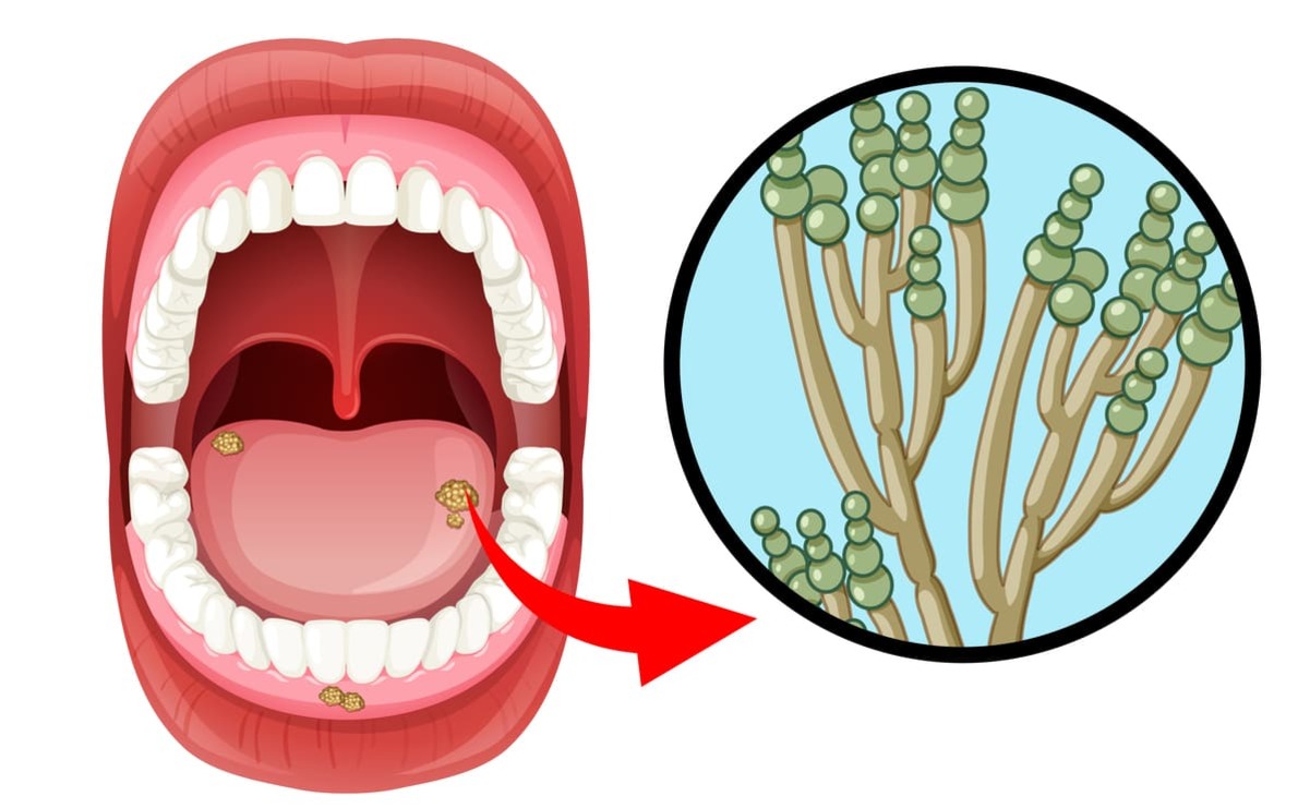 Pilz im Mund - Candida albicans