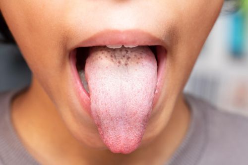 Patienten mit Pilzbefall im Mund